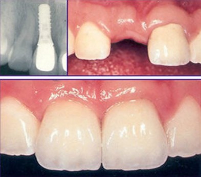 单颗牙缺失修复的3种常用方法