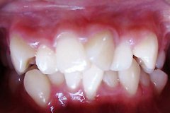 牙齿不齐是有哪些原因造成的呢?